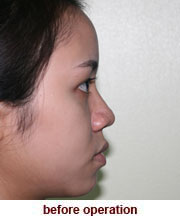 plastic_surgery_augmentation_rhinoplasty